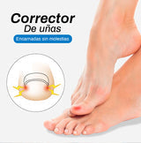 Corrector de Uñas encarnadas